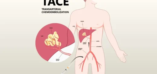 Chemoembolization for Liver Tumor Treatment with Dr. Mahmoud Ghalab
