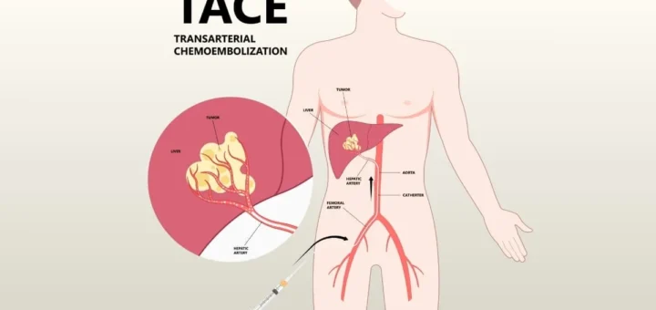 Chemoembolization for Liver Tumor Treatment with Dr. Mahmoud Ghalab