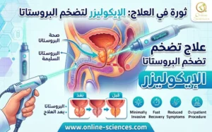 EchoLaser الإيكوليزر لعلاج تضخم البروستاتا 2026: أحدث علاج بدون جراحة مع المميزات والعيوب والتكلفة EchoLaser الإيكوليزر لعلاج تضخم البروستاتا 2026: أحدث علاج بدون جراحة مع المميزات و العيوب و التكلفة